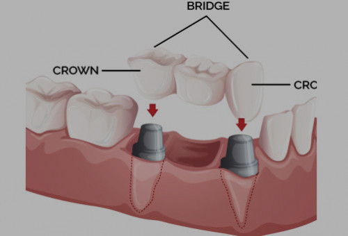 Crowns and Bridges Auckland