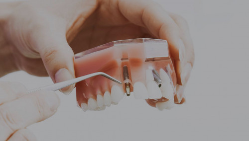 Dental-Implants-Auckland.jpg