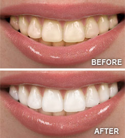 Teeth-Whitening.png